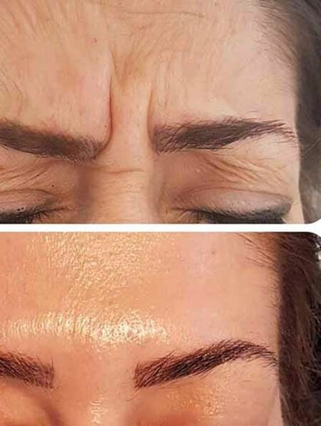 Botox Injections